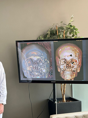 Cirurgia in&eacute;dita &eacute; feita no Brasil para reconstru&ccedil;&atilde;o facial