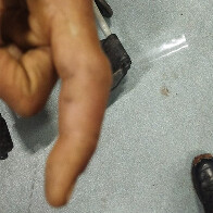 Bombeiros resgatam homem v&iacute;tima de picada de &ldquo;boca de sapo&rdquo; na Codraza em Lad&aacute;rio  