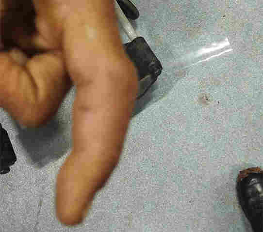 Bombeiros resgatam homem v&iacute;tima de picada de &ldquo;boca de sapo&rdquo; na Codraza em Lad&aacute;rio  