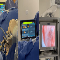 Humap-UFMS realiza cirurgias de pr&oacute;stata com laser de alta pot&ecirc;ncia em pacientes do SUS
