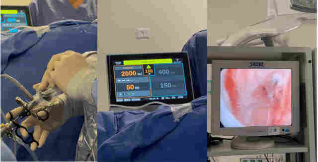Humap-UFMS realiza cirurgias de pr&oacute;stata com laser de alta pot&ecirc;ncia em pacientes do SUS